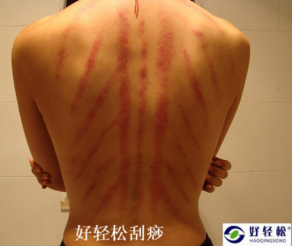 痧状显示健康状态 痧状显示健康状态