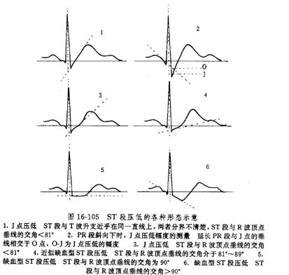 隐匿型冠心病的诊断 隐匿型冠心病的诊断