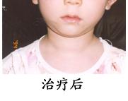 甲亢肌无力治疗 甲亢肌无力治疗